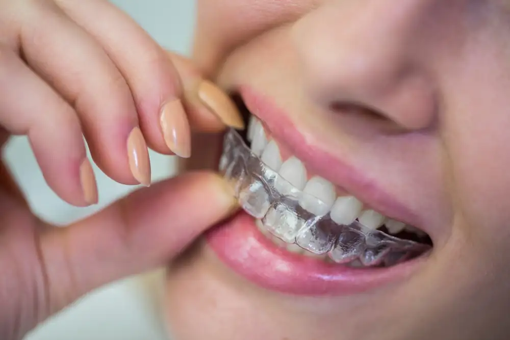 Mulher encaixando o alinhador ortodôntico transparente nos dentes