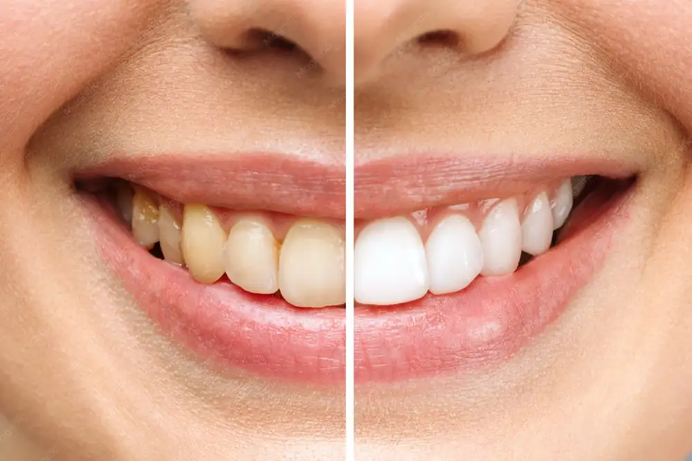 Comparação do mesmo sorriso antes e depois do clareamento dental