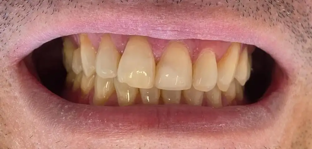 Sorriso do paciente antes do tratamento