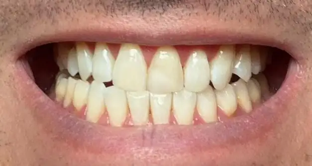 Sorriso do mesmo paciente depois do tratamento