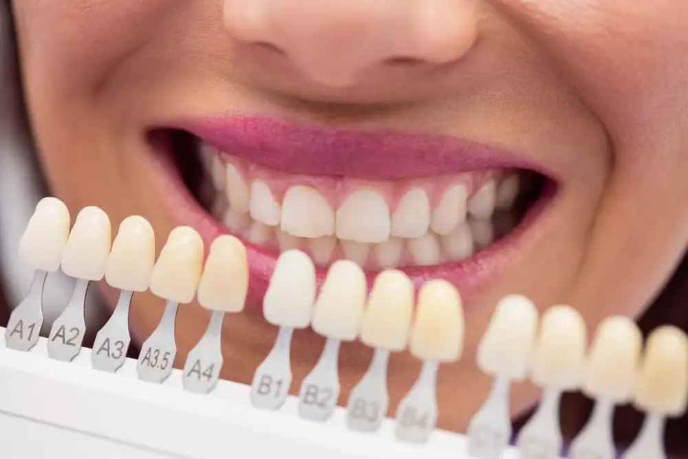 Escala de cores sendo comparada ao sorriso da paciente durante a avaliação