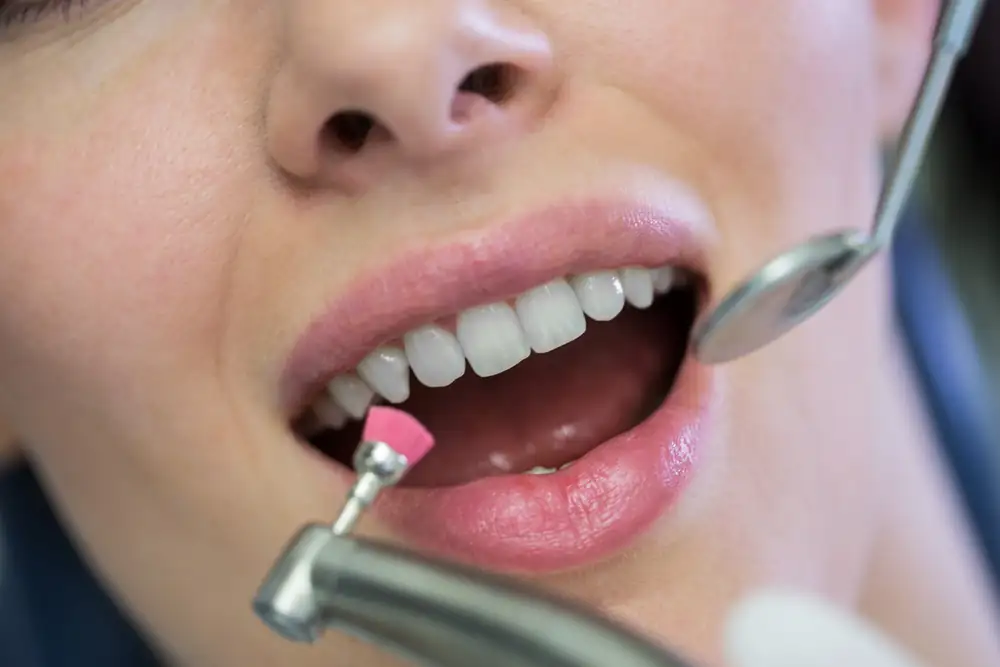 Polimento dental durante atendimento no consultório