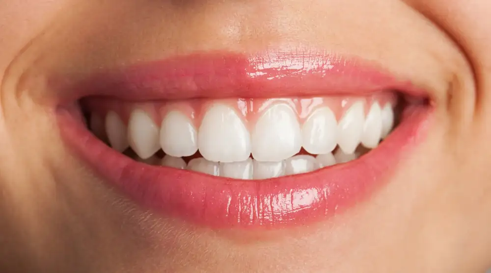 Sorriso com dentes clareados
