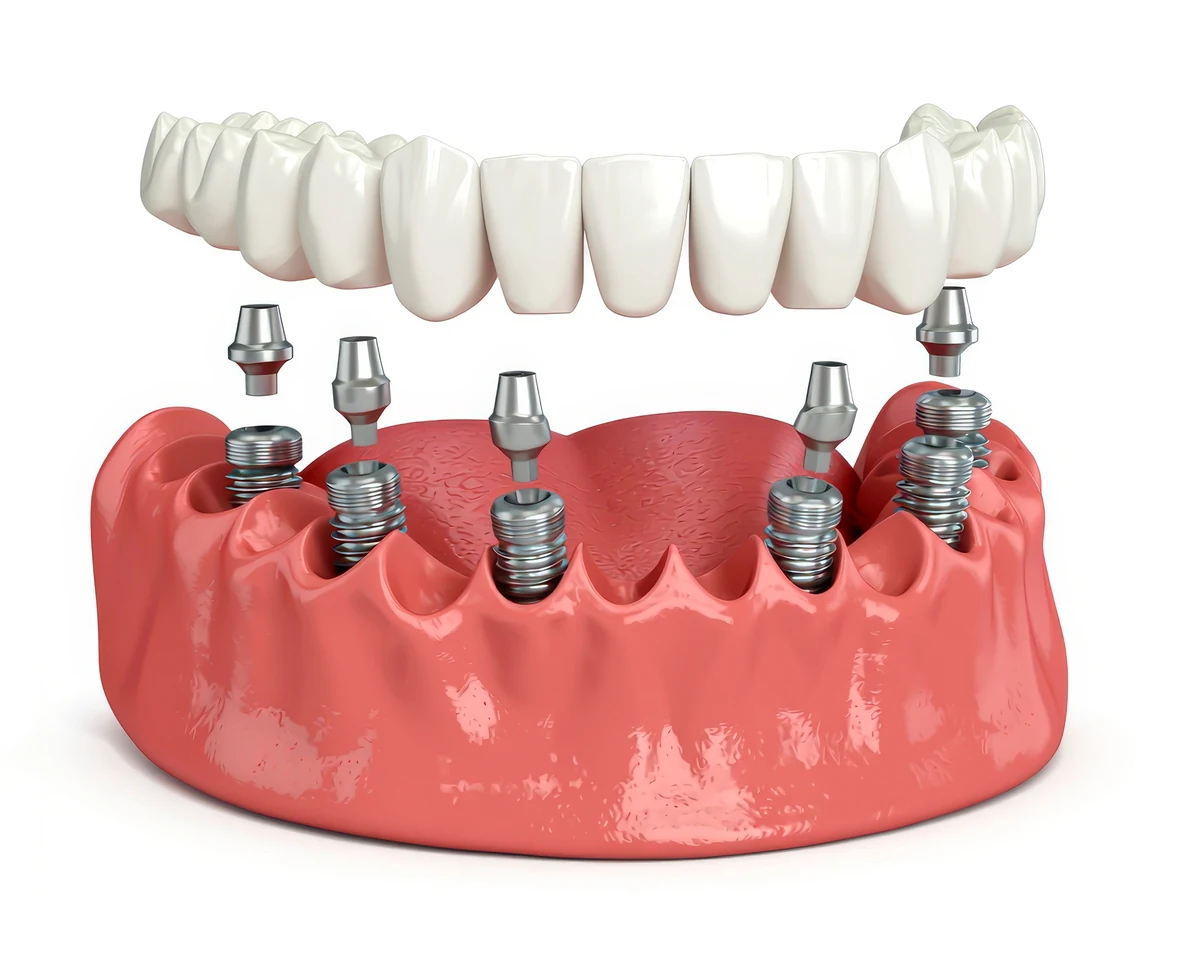 Ilustração de prótese fixa sobre implantes dentários